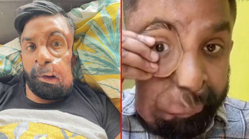 Sosyal medya bu adamı konuşuyor! Canlı yayında gözünü çıkardı, TikTok fenomeni oldu