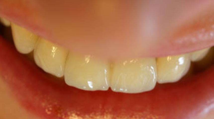 Hamilelik sırasında diş tedavisi