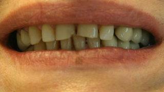 Çürük diş kalp hastalığına yol açıyor
