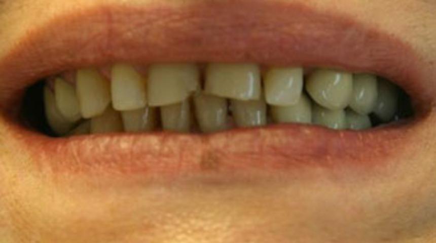 Çürük diş kalp hastalığına yol açıyor