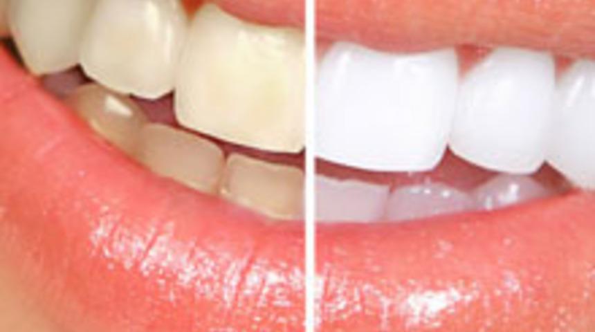 Dişlerim Bembeyaz Olsun