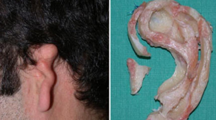 Kulağı olmayan hastaya kaburgasından kulak