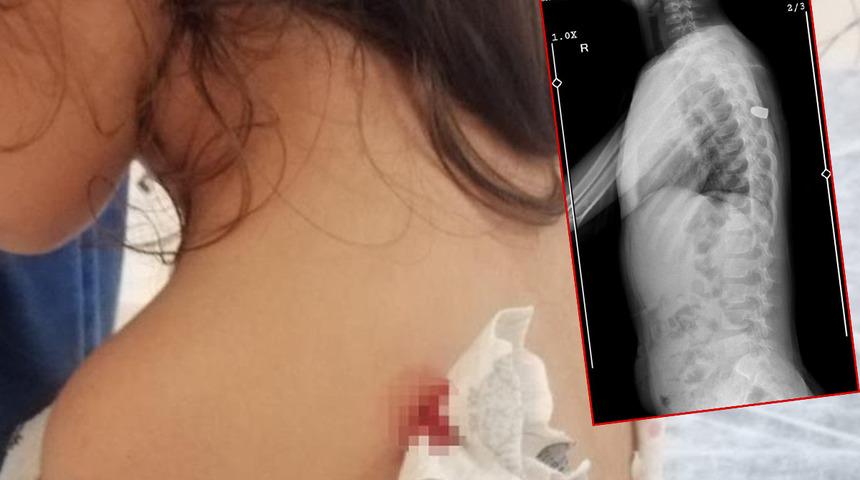 Böcek ısırığı sandılar, gerçek bambaşka çıktı! Aile öğrendiğinde neye uğradığını şaşırdı