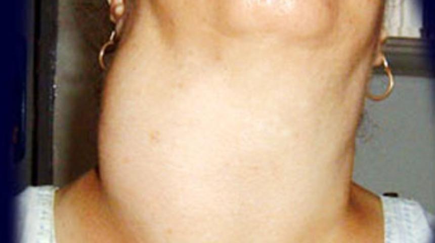 Guatr hastalığında erken tedavinin &ouml;nemi