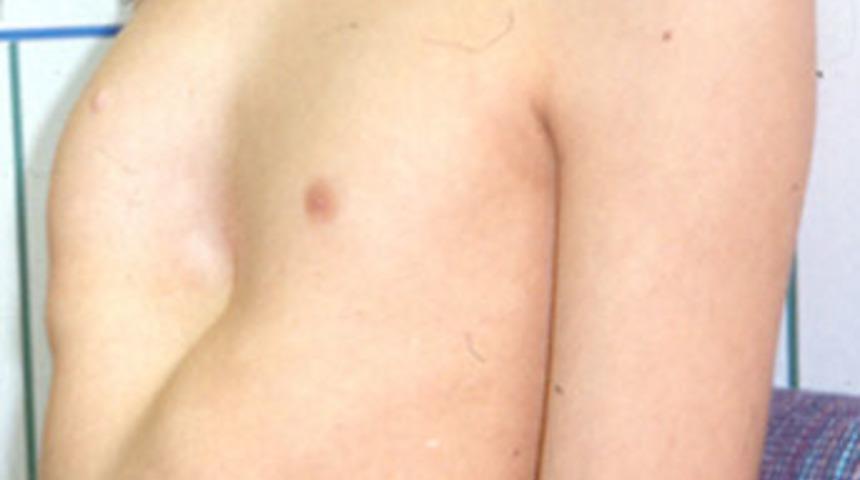 "G&ouml;ğ&uuml;s &ccedil;&ouml;k&uuml;kl&uuml;ğ&uuml;" artık kader değil