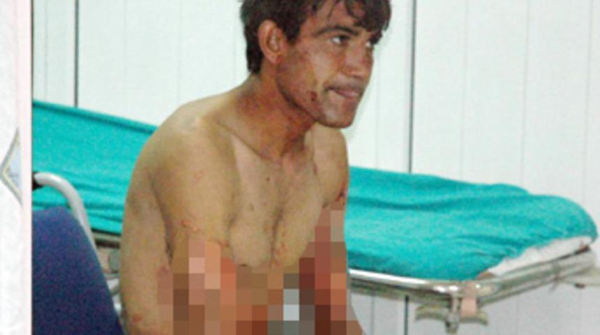 Sevgilisinin yakınları su ile haşladı