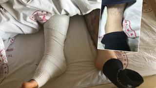 'İşaretleyip mürekkeple boyadı' Narkozun etkisi geçince büyük şok yaşadı! 'Yanlış ayağımdan ameliyat ettiler' iddiası