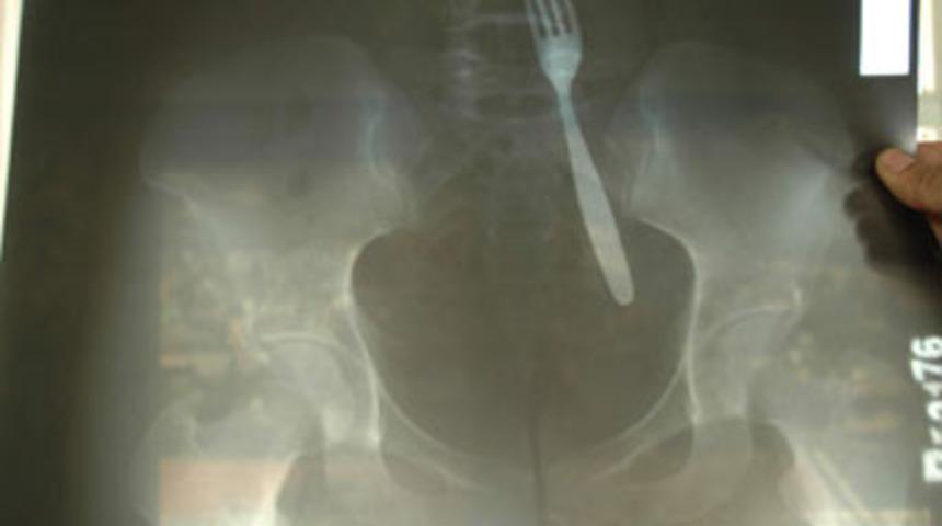 Yıllarca midesinde &ccedil;atalla yaşadı