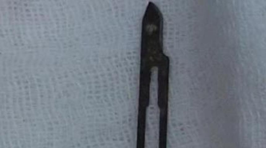 18 yıl sırtında ameliyat bı&ccedil;ağı ile yaşadı