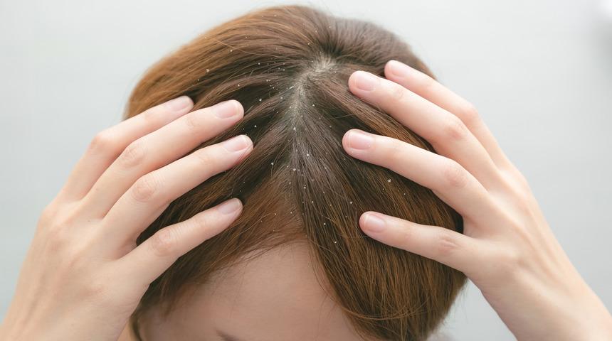 Kepek neden olur, nasıl geçer? Saçtaki kepek nasıl önlenir?