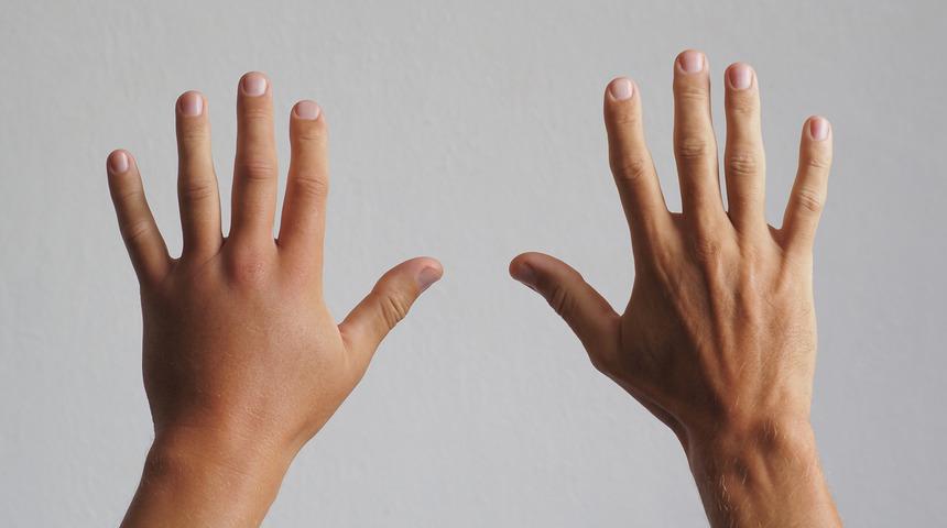 Ödem neden olur, nasıl geçer? Ödeme ne iyi gelir?