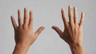 Ödem neden olur, nasıl geçer? Ödeme ne iyi gelir?