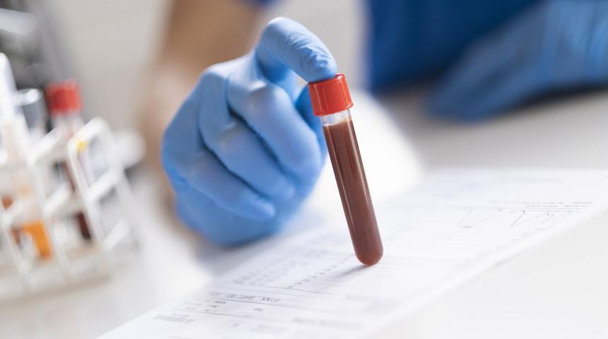 Hemoglobin yüksekliği neden olur? Hemoglobin (HGB) normal değerleri kaç olmalı?