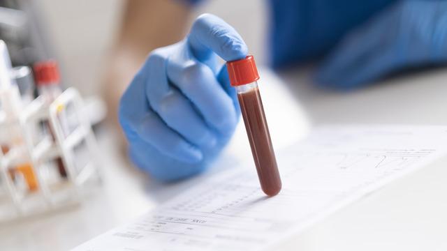 Hemoglobin yüksekliği neden olur? Hemoglobin (HGB) normal değerleri kaç olmalı?