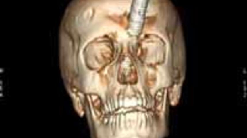 Kafasına demir &ccedil;ubuk saplandı, &ouml;lmedi