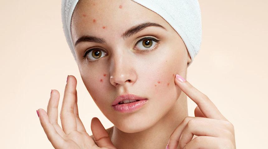 Sivilcelerinizden bir haftada kurtulun! Cilt kusurlarına veda ettiren formül, yüzünüz bebek gibi olacak