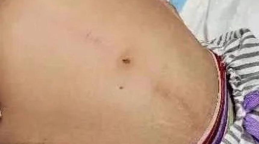 Karnını görenler hamile olduğunu düşündü! 10 gündür tuvaletini yapamıyordu... 3 metrelik dışkı çıktı