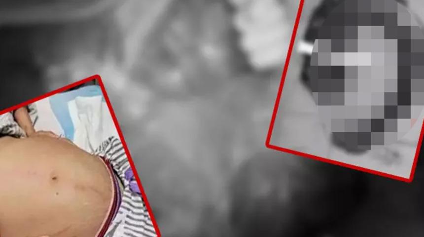 Doktorlar bile gözlerine inanamadı! Midesinden tam 3 metre uzunluğunda ve 20 kilogram ağırlığında...