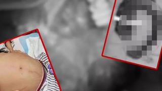 Doktorlar bile gözlerine inanamadı! Midesinden tam 3 metre uzunluğunda ve 20 kilogram ağırlığında...