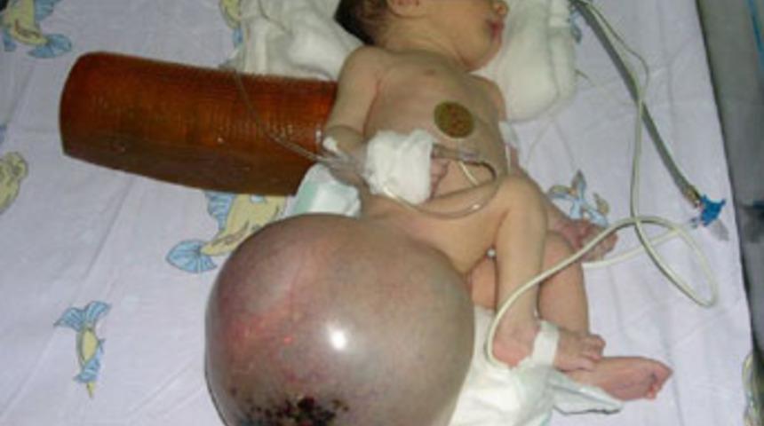 Minik bebek ağırlığı kadar t&uuml;m&ouml;rden kurtuldu