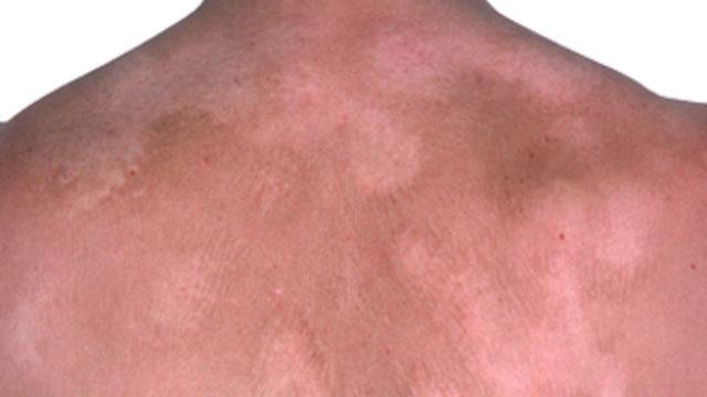 Beyaz leke hastalığı Vitiligo yayılır mı?
