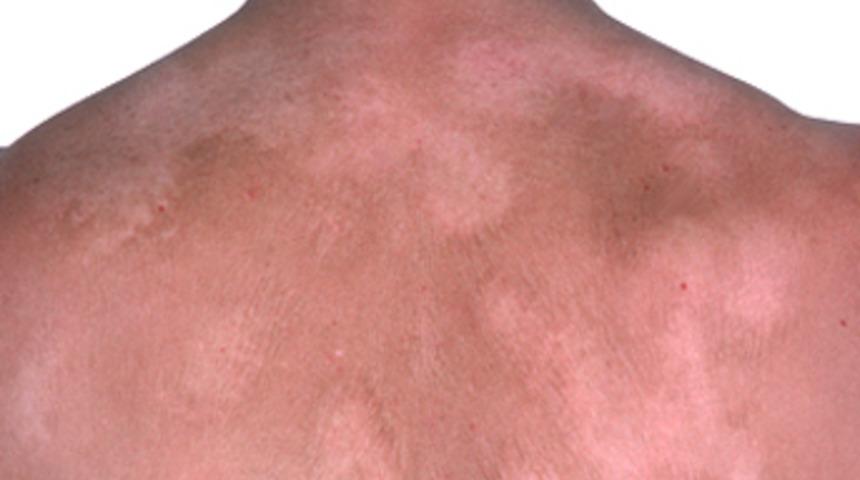 Beyaz leke hastalığı Vitiligo yayılır mı?