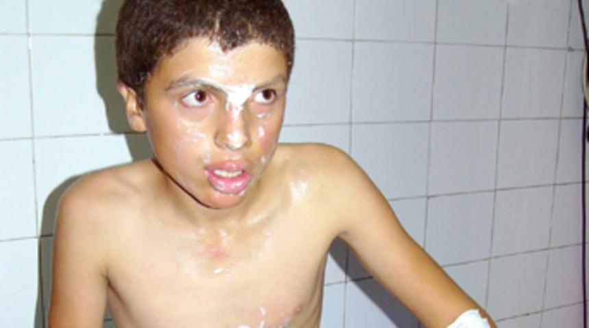 Tiş&ouml;rt&uuml;ne kolonya d&ouml;kt&uuml;, alevler i&ccedil;inde kaldı