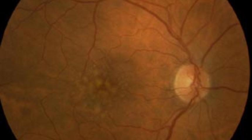 Sarı nokta'nın artık tedavisi var