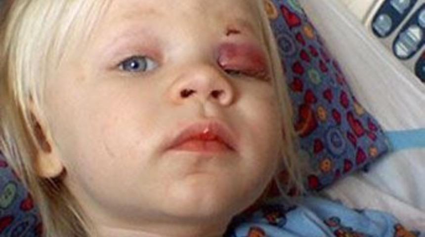 G&ouml;z&uuml;ne tornavida soktu, &ouml;lmedi