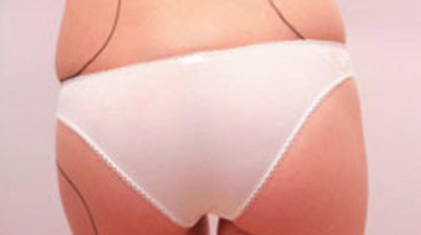 B&ouml;lgesel Zayıflama Y&ouml;ntemi; Ultrakavitasyon