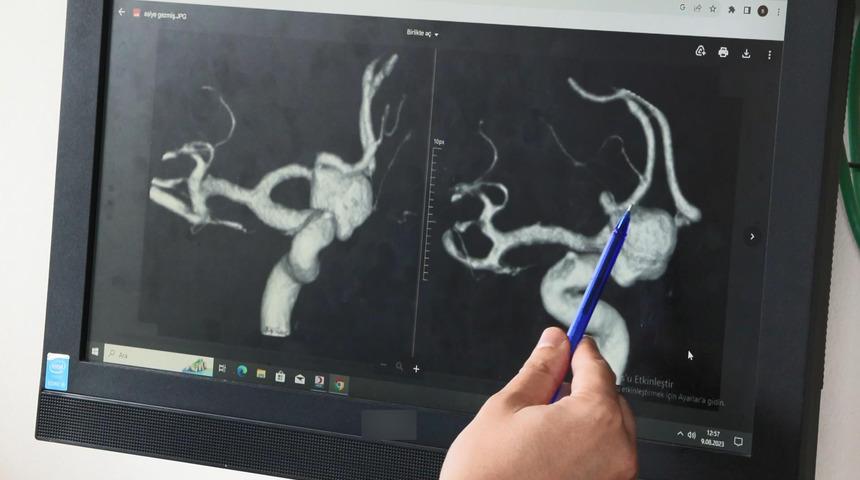 O durum sonrası dört hastadan sadece biri kurtarılabiliyor! Ölümcül beyin anevrizmasıyla ilgili yeni keşif
