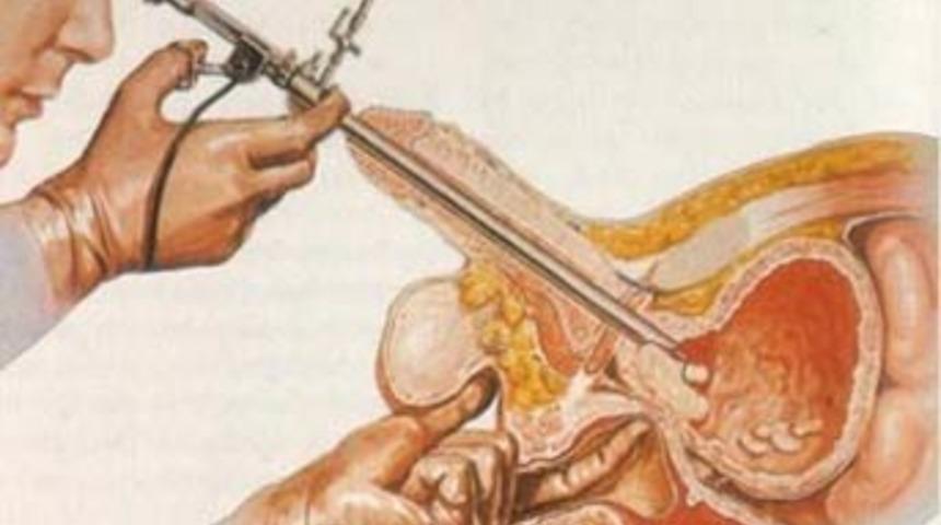 Aktif cinsel hayatla gelen prostat kanseri riski