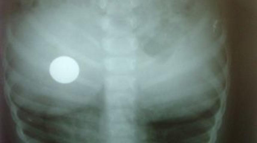 Oyun oynarken madeni parayı yuttu