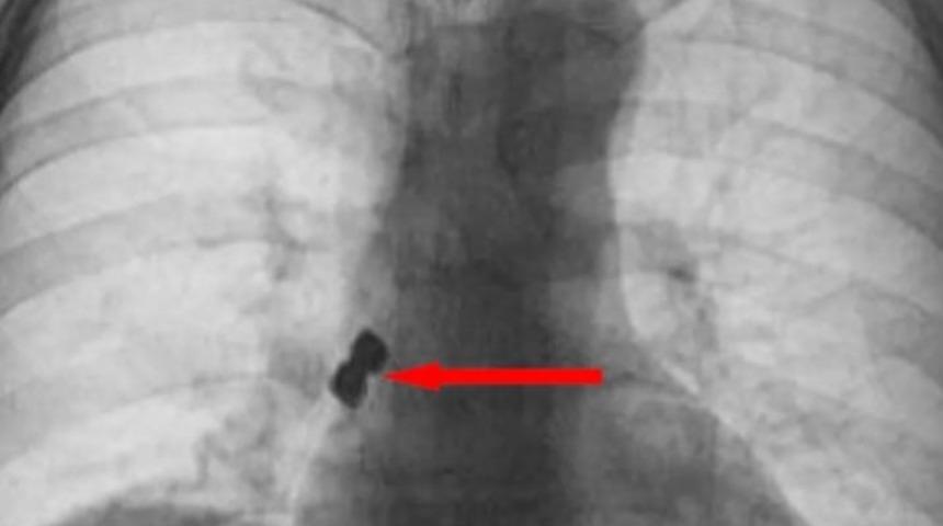 Diş tedavisinde hastanın başına geleni duyanlar şaştı kaldı
