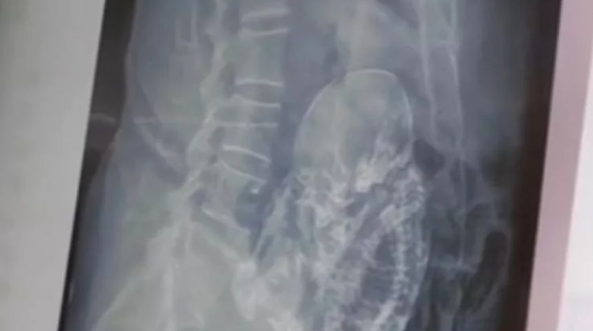 Tam 40 yıldır oradaydı! Kimse ne olduğunu anlayamadı... Kireçlenmiş fetüsü gören doktorlar şaşkınlığını gizleyemedi