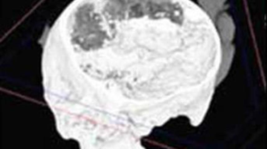 2 bin yıllık 'demir' beyin bulundu