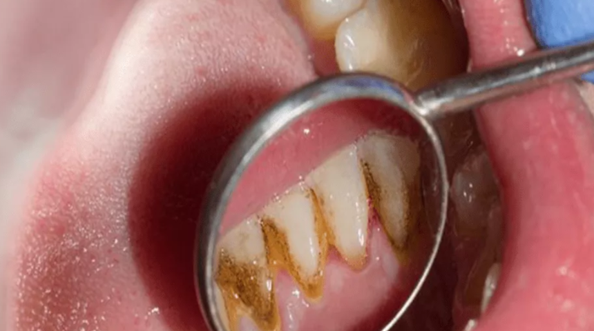 En etkili yöntem! Diş tartarı ve taşlarını anında temizliyor
