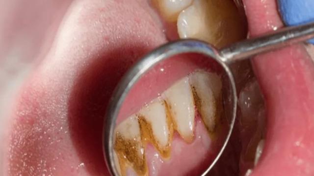 En etkili yöntem! Diş tartarı ve taşlarını anında temizliyor