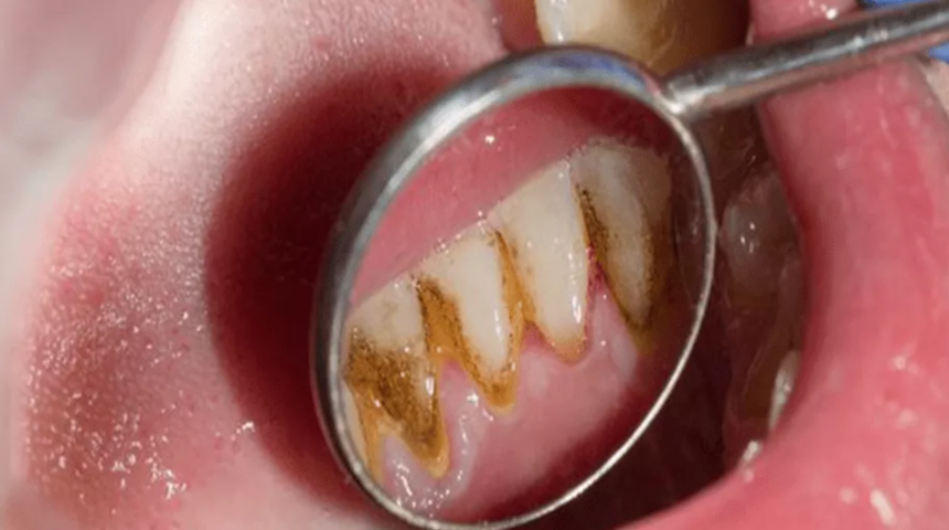 Diş tartarı ve taşlarına son! Dişlerinizi inci gibi parlatmanın en etkili yolu