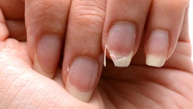 Bu belirtilere dikkat! Dış görünüşünüzden tahmin edebileceğiniz vitamin eksiklikleri