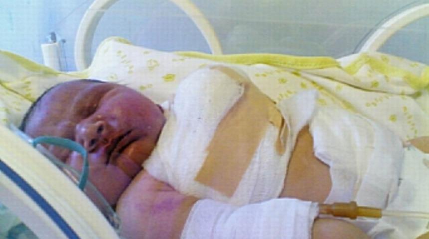 Doğum sırasında bebeğin kolları kırıldı