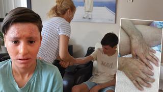 15 yaşındaki Kayra'nın trajik hikayesi... Gündüz sokağa çıkamıyor: Görenler 'Çocuğun yandı mı?' diye soruyorlar!