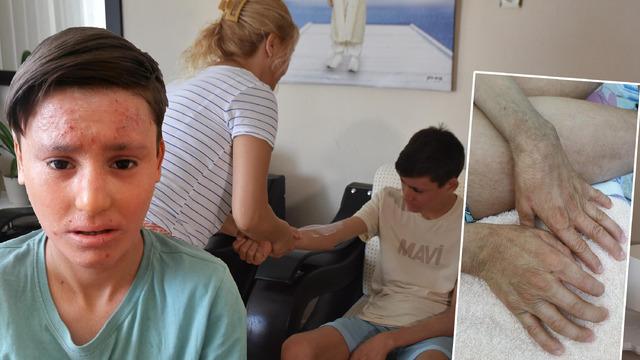 15 yaşındaki Kayra'nın trajik hikayesi... Gündüz sokağa çıkamıyor: Görenler 'Çocuğun yandı mı?' diye soruyorlar!