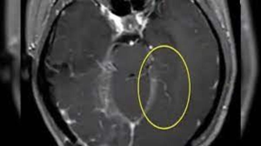 Unutkanlık ve depresyon şikayetiyle hastaneye başvurdu! 64 yaşındaki kadının beyninden canlı solucan çıkartıldı