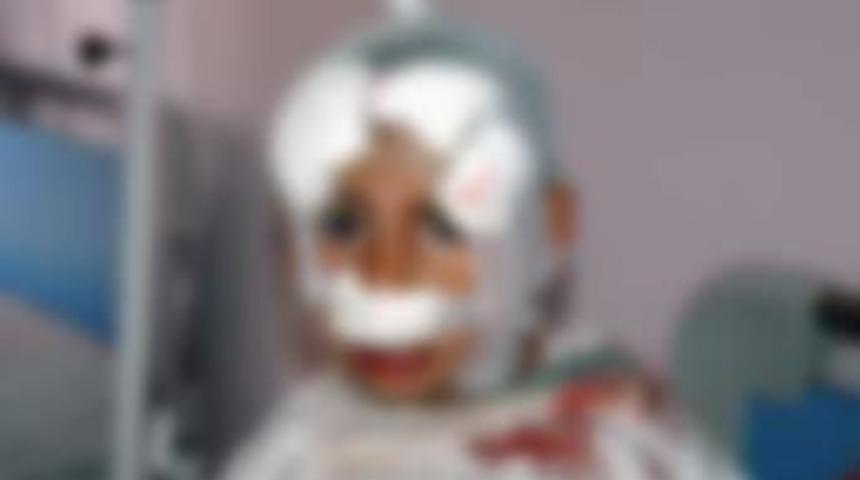 Oynadığı k&ouml;pek burnunu kopardı