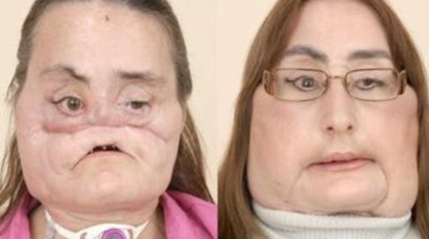 Y&uuml;z nakli yapılan kadın y&uuml;z&uuml;n&uuml; g&ouml;sterdi