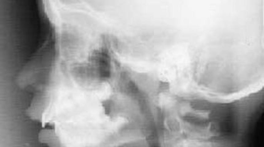 Y&uuml;z&uuml;ndeki kurşunu 12 yıl sonra farketti