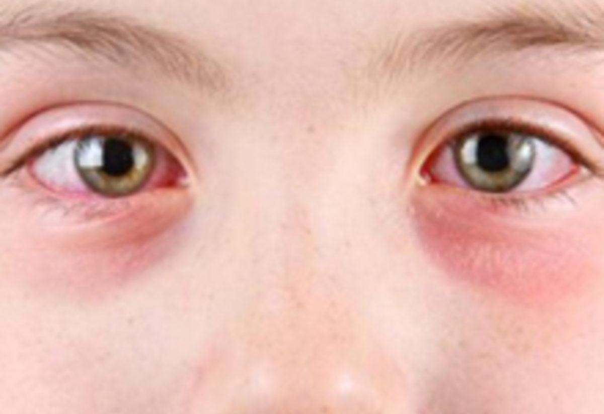Конъюнктивит 10 лет. Аллергический конъюнктивит глаза у детей. Аллергическийконъюктивит у ребёнка.