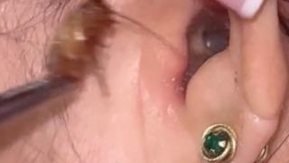 Mide bulandıran an! Geçmeyen baş ağrısı şikayetiyle doktora gitti... Kulağından canlı hamam böceği çıktı