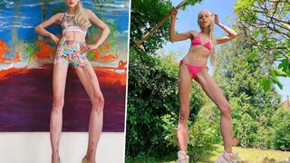 Boyunu 15 cm uzatmak için ameliyat oldu! Operasyonun fiyatı dudak uçuklattı... “Çok pişmanım”